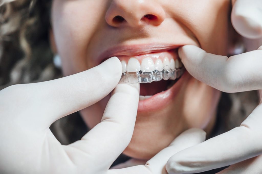 Beneficios de la ortodoncia invisible