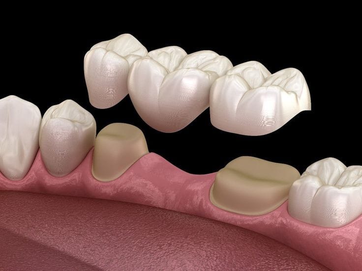 Son dispositivos artificiales removibles , realizados en un material llamado acrílico, rígido, donde por medio de una impresión sea digital o análogo se evalúan los arcos dentarios , para restablecer los dientes perdidos.