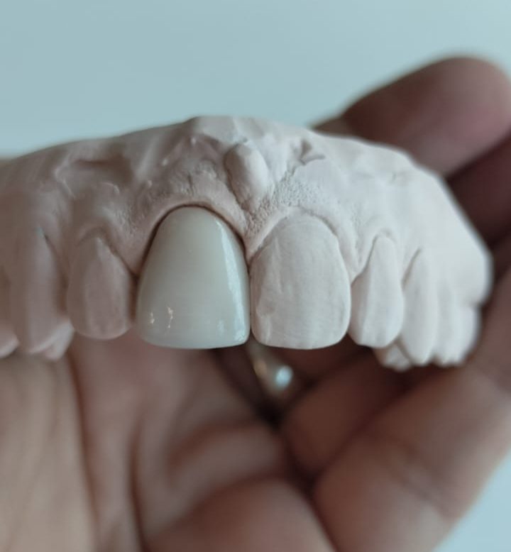 Utilizadas en el Diseño de sonrisa y ayudan a devolver forma, función y estética.