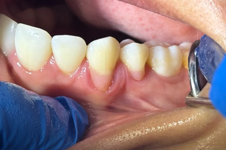 La retracción de encías es una condición en la que el tejido gingival se desplaza hacia atrás, dejando expuesta una mayor superficie del diente o incluso la raíz-colombia