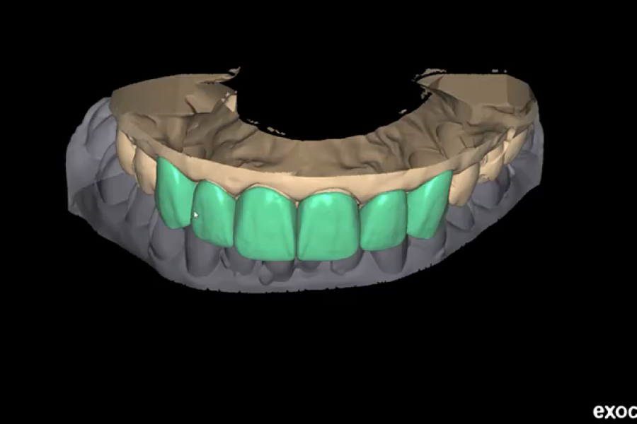diseño de sonrisa 3d perfectsmile